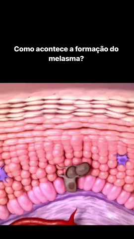 ✨ **Como o Melasma é Produzido?** ✨ Melasma é uma condição de pele que causa manchas escuras, geralmente no rosto. Mas você sabe como ele se forma? 1. **Estímulos Externos**: A exposição ao sol é o maior vilão! Os raios UV estimulam a produção excessiva de melanina, o pigmento que dá cor à pele.     2. **Hormônios**: Alterações hormonais, como durante a gravidez ou uso de anticoncepcionais, também podem desencadear o melasma.     3. **Genética**: A predisposição genética também desempenha um papel importante. Se alguém na sua família tem melasma, você pode ter uma maior chance de desenvolvê-lo. 4. **Inflamação**: Qualquer inflamação ou lesão na pele pode ativar melanócitos, as células que produzem melanina, levando ao melasma. #estéticafacial #fyp #paravoce #cuidadoscomapele 