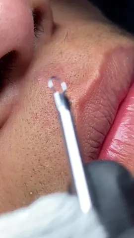 #puntosnegros #extracciones #extractions #skincare #satisfyingvideo #extraccionpuntosnegros 