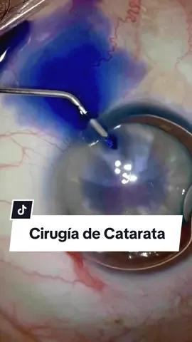 🔬 #CirugiaDeCatarata · ¿Qué es el líquido azul que ves en el video? Conoce el Azul de Tripan. Este tinte se utiliza para teñir los cristalinos densos, mejorando la visibilidad de los bordes de la cápsula anterior con nitidez y contraste durante la capsulorrexis. La capsulorrexis es una apertura precisa en la cápsula del cristalino, que permite al facoemulsificador (el equipo utilizado para operar las cataratas) trabajar de manera más efectiva. Esta es otra demostración de cómo realizamos la cirugía de catarata; un procedimiento seguro que le devuelve la visión a las personas, para que así recuperen su independencia y calidad de vida. 💭 Si estás interesado en conocer más información sobre este procedimiento, comenta 