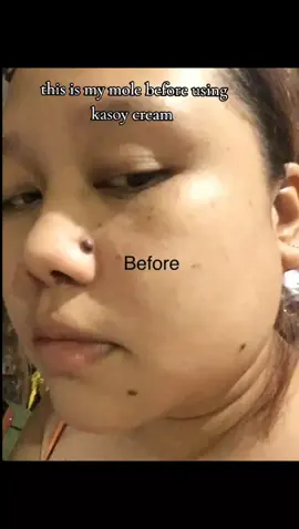 #kasoycream #kasoycreamwarts #wartsremoval #wartsremover #moleremoval #mole #fyp 