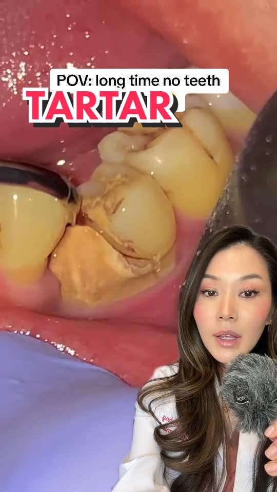 Dentistry Explained Episode 789 | Tartar can buildup and wedge itself into these hard to clean areas!  creator credit @doktergigi_  #hygienist #satisfyingcleans  #greenscreenvideo 