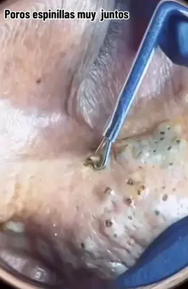 #poros #acne #extraciones #granos #espinillas #puntosnegros #relax 