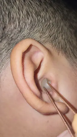 #foryou #pimple #earwax #earwaxremoval #earcleaning #earwaxirrigation #blackhead #