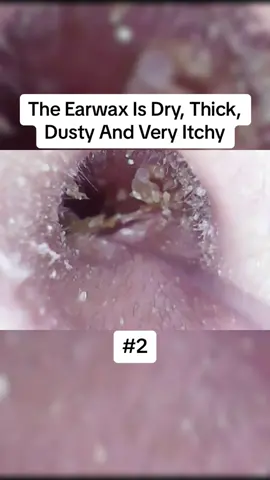 The Earwax Is Dry, Thick, Dusty And Very Itchy Part 2 #earwax #ear #earwaxing #fyp #foryou #asmr #earwash #earcleaning #earwaxcleaner #foreignbodyremoval #doctors #earwaxremoval #removing #earcleaningasmr #washing #relaxingvideos 