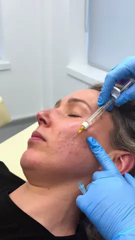 Treating skin inflammation caused by acne with polynucleotides 💉💧 #vitaran #acnescarring #acnetreatment #polynucleotides #skincare 