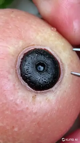 #satisfying #pilimultigemini #blackhead #squeeze #pimple #dermatology #neverfear