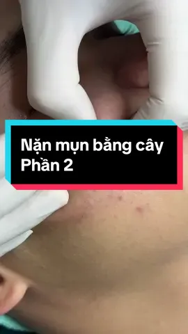 Nặn mụn bằng cây p2#xuhuong #winspavungtau #spa #xuhuongtiktok 