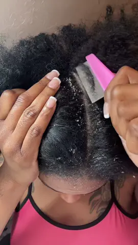 The flea comb was actually okay. Slightly differs from the combs i use  #sebboricdermatitis #sebborheicdermatitis #dandruff #dandruffremovel #asmr #scratch #scratchingasmr #flakes 