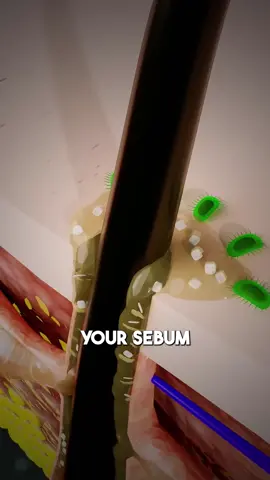 Acne caused explained in 3d #pimples #acne #animation 