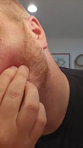 This pop caught me off guard #pimples #pop #fy #fyp #pimple #satisfying 