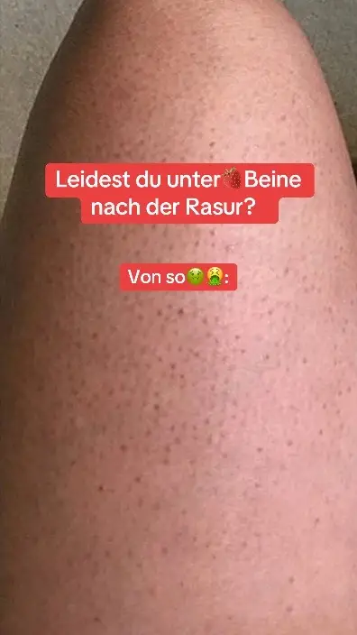 #fyp #erdbeerbeine #tipps #rasieren #frauen #BeautyTok 