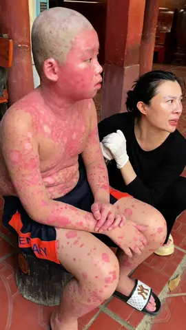 Vẩy nến khi nó tan dần dần ạ#thituyendc35_2 #ongbao369 #vaynen 