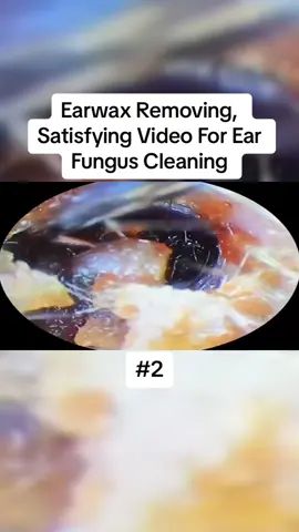 Earwax Removing, Satisfying Video For Ear Fungus Cleaning Part 2 #earwax #ear #earwaxing #fyp #foryou #asmr #earwash #earcleaning #earwaxcleaner #foreignbodyremoval #doctors #earwaxremoval #removing #earcleaningasmr #washing #relaxingvideos 