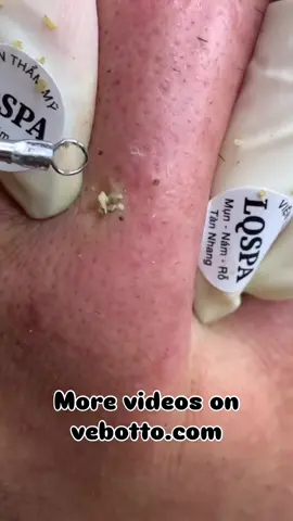 More Videos visit 👉  vebotto.com  Link in Bio 🤩  #pimple #blackheads #popping #pimplepopping #pimplepop #blackheadremoval #ingrownhair