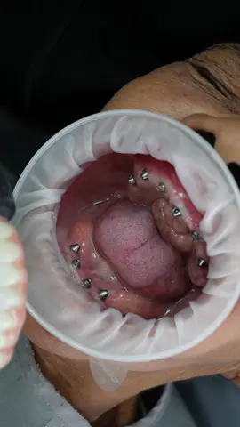 Rehabilitacion Oral Sobre Implante  #implant #ceramicadental #hibrida #implantesdentales #diseñodesonrisa #straumann 