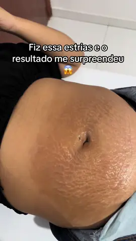 Remoção de estrias 🚨 #estrias #estriasbrancas #estriascheck 