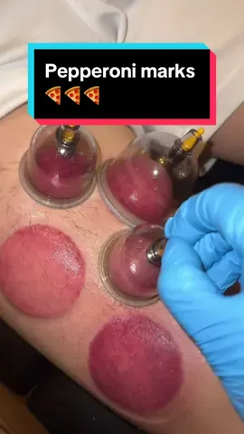 Cupping the Quadriceps🍕 • Disclaimer ‼️: DO NOT TRY THIS AT HOME. All treatments seen are part of an ongoing treatment plan, carried out by qualified and experienced therapists. ##fyp##london ##cupping##cuppingtherapy##asmr##asmrsounds##manualtherapy ##chiro##mchiropractic#chiropractor