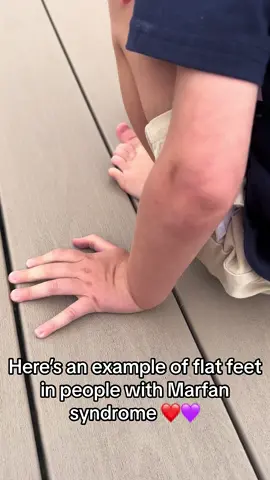 Connors feet are extremely flat. Its part of his condition. Im so thankful he can walk ❤️💜 #foryou #foryoupage #awareness #raiseawareness #raiseyourvoice #MomsofTikTok #moms #momlife #medical #medicalmom #jouney #viral #viral #viraltiktok #boymom #spreadlovenothate #medicallycomplex 