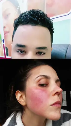 Maxaa keena gaduudka wajiga manta baro#somalitiktok #drakdermaclinic #fyp #rosacea #facialredness #muqdisho 