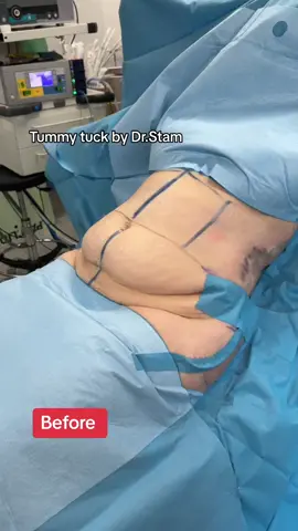 #tummy #tuck #skin #laxity #looseskin #fyp #fypage #tiktok #viral 