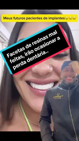 Com as facetas de resinas mal adaptadas, ocasionando inflamação gengival, perda de estrutura óssea, gengival até a perda dos dentes. os pacientes de resinas mal feitas de hoje serão meus pacientes de implantes  amanhã . #faceta #resina #lentesdecontacto #facetasderesina 