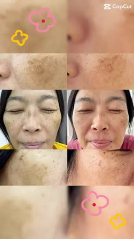 Pudar bintik-bintik dan jeragat di muka脸部雀斑、斑点淡化  PM60146399434 Not miracle pill must...... After a month of consuming (1 - 2 bottles), it indeed has shown some improvement as per the picture shown. #indonesia🇮🇩 #singapore #malaysia #livcore #aulorapantswithkodenshi #layhoon #fyp 