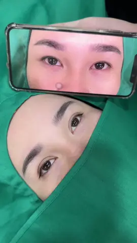 Nhấn mí #nhanmi #binhduong #xuhuong 