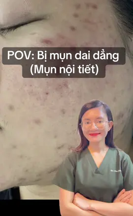 Bạn có hay bị nổi mụn ở những vị trí này và hay tái phát hoài không? Có thể bạn đang bị mụn nội tiết đó #drthuphong #LearnOnTikTok #trimun #chamdakhoahoc 