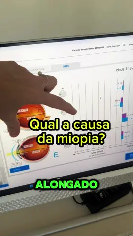 👓Vamos falar sobre os diferentes tipos de miopia! Sabia que ela pode ser classificada de várias maneiras? Confira: 1️⃣ **Miopia axial**: Ocorre quando o globo ocular é mais longo do que o normal, fazendo com que a luz se foque antes de chegar à retina. Essa é a forma mais comum de miopia. 2️⃣ **Miopia corneana**: Relaciona-se com a curvatura excessiva da córnea, que também faz a luz se concentrar antes da retina. Isso pode ser corrigido com lentes ou cirurgia. 3️⃣ **Miopia pelo alto poder da lente do cristalino**: Neste caso, o cristalino tem um poder de refração elevado, resultando em uma visão borrada para longe.  💡 Conhecer os tipos de miopia é fundamental para um tratamento adequado! Se você ou alguém que você conhece sofre com a miopia, e não aguenta mais usar óculos, clique no link da bio e busque as melhores opções de correção. Sinta-se livre de novo! ⛓️‍💥✨ #miopia #lasik #cuidadoscomosolhos 