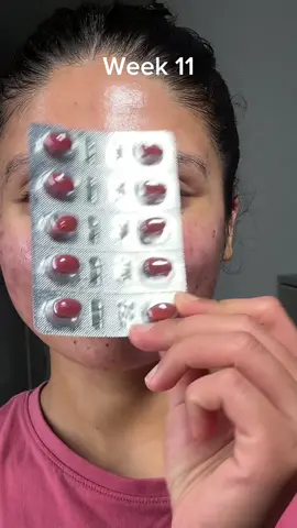 Skin update:- Week 11 on Accutane✌️✌️ Skin is very sensitive and red, experiencing some new breakouts, severe nosebleeds, dry skin lips and eyes, back pain, and unstable mood  #acneproneskin #acne #accutanejourney #accutane #acnejourney #accutanesideeffect #skinupdate #skinupdate #acneskin #acnefighter #acnefighter #acnepositivity #acnespot #accutanecheck #acnetreatment 
