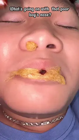 #foryou #earwax #ear#earwaxremoval #earwaxcleaning#satisfying #fyp 