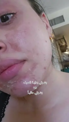 يمكن هذا الصيف هو اكثر صيف عانيت بي لأن بشرتي تحولت من سيء الى اسوء وهذا الشي جدا يأثر على النفسية وعلى الاداء. صعب واحد يستمر بالعناية وبشرته دتسوء بس وبس. جان السبب هو الحر والهرمومات واكيد النظام الغذائي الغلط. الحمدلله هسه حيل فرحانة من خلصت منهم وارتاحيت 😍😍 أنشالله راح اخبصكم بالأشياء الي فادتني وحسنت من الاثار ودرع البشرة. وأنتم شنو تجاربكم وي حبوب الصيف؟ هم عانيتوا هيج؟ ولو حتى لعدوي ما اتمناها . .. . . . .  #explor #fyp #beforeandafter #acnetreatment 
