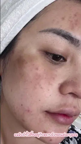 ถ้าเรามีผิวหน้าที่พังทลาย ก็หมดความมั่นใจไปเลยนะ เราเป็นคุณแม่หลังคลอด ก่อนนี้ ผิวพังมาก แต่ใช้เวลาไม่นานที่กู้กลับมาได้ ตัวนี้เบยจ้า #jkสกินแคร์ที่จริงใจกับผิวคุณ #JKxLAB