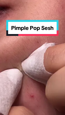 Lancets make all the difference in not inflamming your skin during popping sessions fr #acne #pimplepop #pimplepatch #relatable #extractions #satisfying 