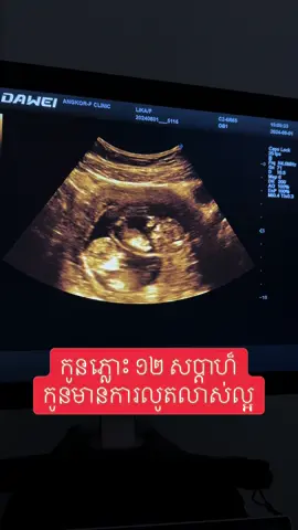 កូនភ្លោះ ១២ សប្តាហ៏ #ឯកទេសរោគស្រ្តីនឹងការបង្កកំណើត #angkorfclinic #IUI #IVF 