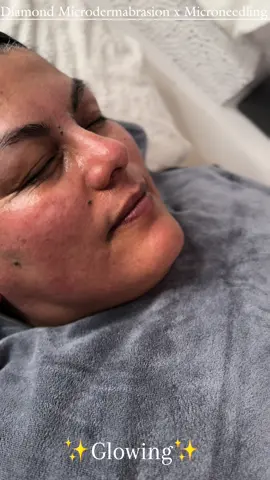 Diamond Microdermabrasion x Microneedling 🤩✨ #new #nrw #pulheim #düren #pulheimbeiköln #viral #capcut #fyp #aybeauty #homestudio #beautyroom #by_aybeauty #zeitfürdich #selflove #skin #skincare #microneedling #diamondmicrodermabrasion #microdermabrasion #mikrodermabrasion #diamantmikrodermabrasion #beauty #fresh #cureconcept #shrgermany #babor 