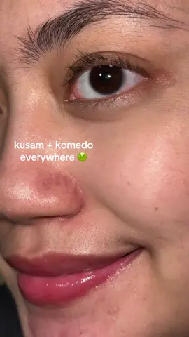 yang punya masalah chicken skin cobain deh + very gentle on my skin! approved by me ✅ #lactidacid #skintific #exfoliating #exfoserum #rekomendasiexfoliasi #serumskintific #skincare 