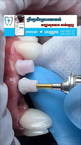 បង្គោលImplantដែលល្អ #070525223 #010505522 #pageដុកទ័រធ្មេញសុខហេងdoktersokheng #sokhengdentalclinic #fypシ #foryoupage #fypシ゚viral #foryou 