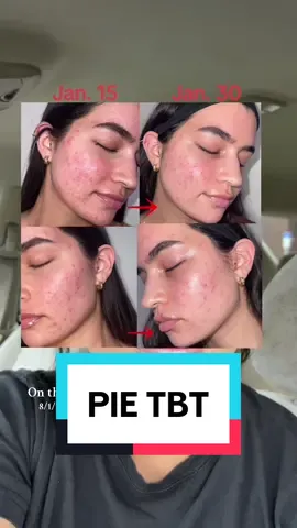 As for topicals, azelaic acid is my all time fav ingredient for PIE! Niacinamide is second. Also, if youre interested in the supplements, I have a c0de: rubsyacne15 #onthisday 