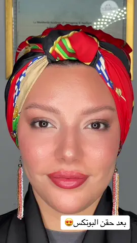 🌟Découvrez la magie du Botox pour un visage sans rides et éclatant de jeunesse ! Notre traitement rapide et efficace vous offre un résultat naturel et durable. Offrez-vous une peau radieuse et lisse en un clin d’œil. Réservez votre consultation aujourd’hui e ! 💉✨ @KHADIJA BOUGUEDRA  📍metamorphose clinic 6 avenue megraoua mohamed Oran  📞0549496574 (pour tte prise de rdz)  #botox #filler #peeling #medecineesthetique  #laser 