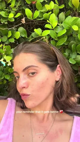 #accutane said clear skin was the only option🙂‍↔️😶‍🌫️🫶🏻 #acnehealing #acnejourney #clearskin #accutanejourney #adultacne #itgetsbetter #transformation 