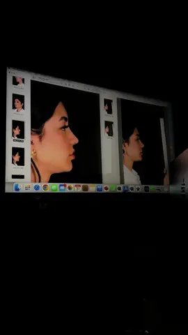 Na primeira consulta já senti muita confiança e marquei a cirurgia com o @Dr Guilherme Sella ✨acompanhem tudooo