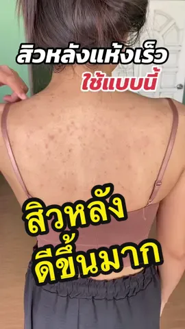 ใช้ดีมากจริง #สิวหลัง #รักษาสิวหลัง 
