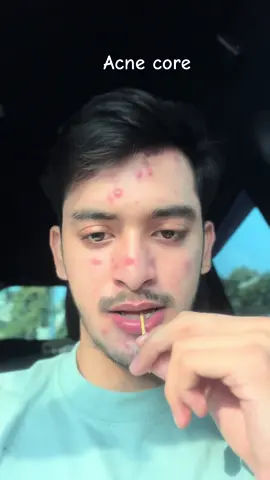 Acne core🤣