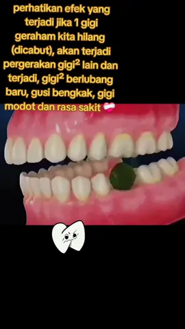 #gigitiruanjembatan #gigipalsulepasan #gigigigi #sakitgigi  #gusibengkak 