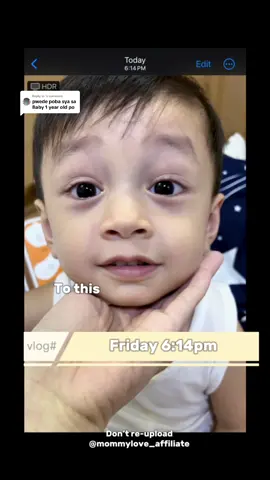 Replying to @ Nag message po ako sa seller kasi Nung july 28 last sunday nagkasugat sa face ang baby ko. Sabi ng seller at any age daw po. Ito po video ginamit ko sa 1 year and 9months old baby son ko. Ito po result sa kanya lst video po kuha ko lang ngayon. #fyp #trending #viral #foryou #scarremoval #peklat #kids #adult #tiktokmademebuyit #honestreviews #family #skincare @Mars Tattoo Ph 