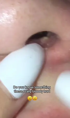 #pimpleremover #pimplepopperaddict #pimples #hajkaaa #japan #sweden #vietnam #fyp #viral 