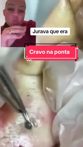 Que tanto de cravo em um lugar so #limpezasatisfatoria #reagindo #terapia #satisfatório #cravos 