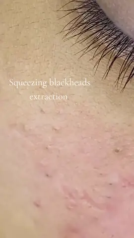 Squeezing blackheads extraction #pimple #blackheads 