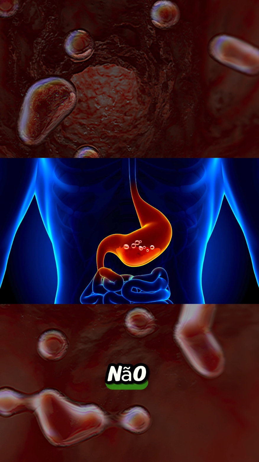 Os sintomas dele eram azia e queimação, veja o que estava causando isso! #queimação #azia #colonoscopia #endoscopia #estomago 